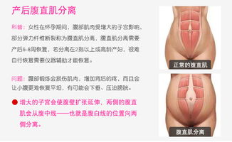产后腹直仪与盆底修复仪 有效性与价格全解析